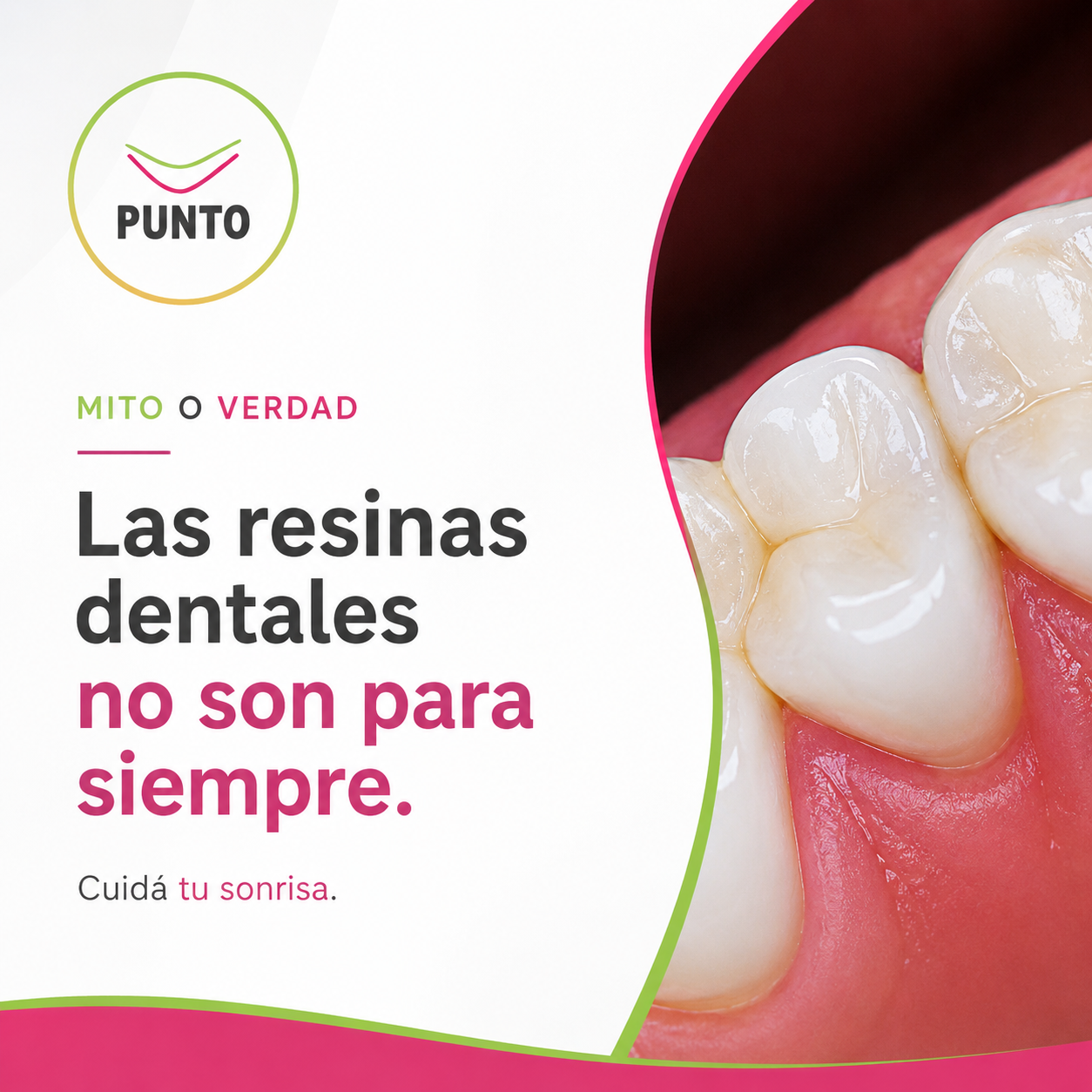 Mito o verdad: las resinas dentales no son para siempre - Punto Odontológico